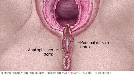 Vaginal tear from sex treatment