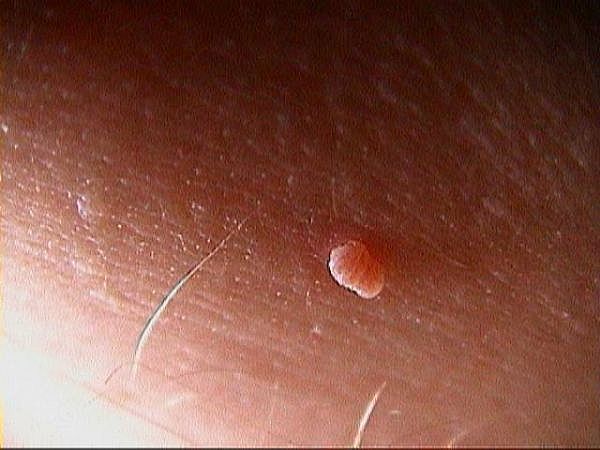 Irritated skin tag on anus