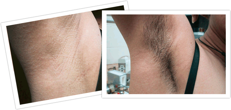 Scratch reccomend Bikini waxing photos before and after