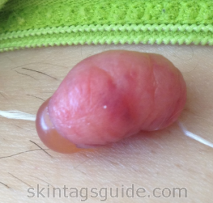 Irritated skin tag on anus